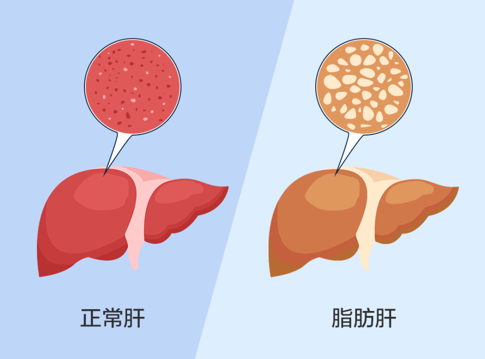 肝脏是怎么越变越胖的?