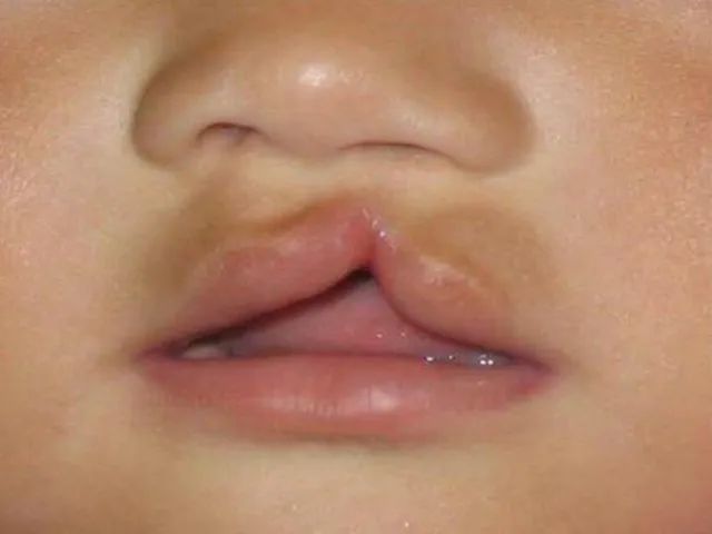 下嘴唇后推牙齿的力量则抑制了下颌骨生长;此外还有口呼吸,吐舌,咬