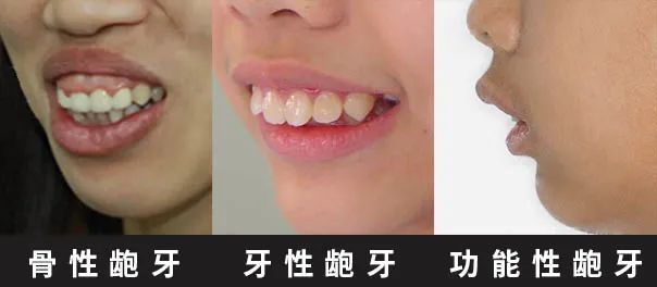 01 牙性龅牙 主要是由于恒牙在生长过程中,由于牙弓过小,导致牙列