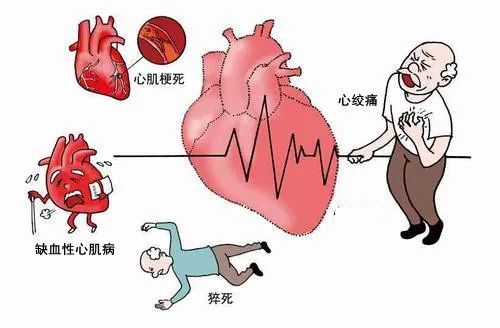 缺血性心肌病 有心绞痛,心肌梗塞病史,心脏逐渐增大,心律失常.