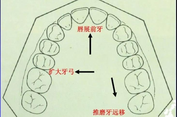 矫正牙齿必须拔牙吗?