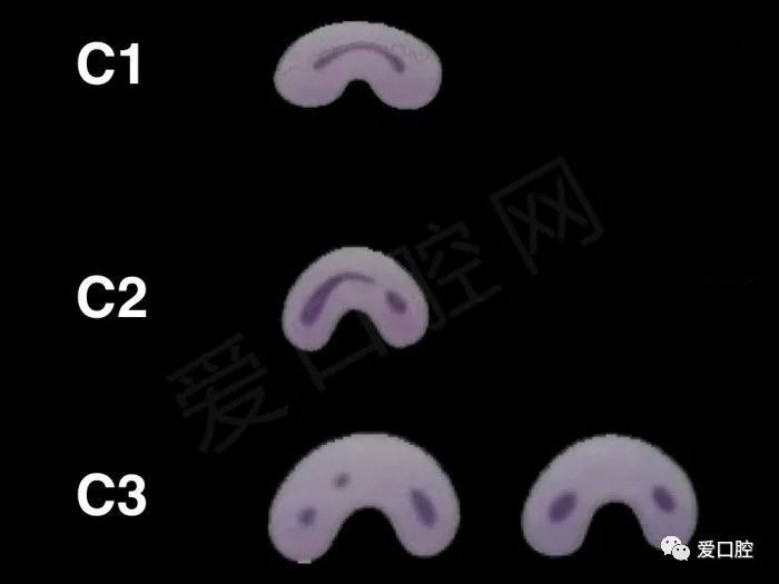 下颌多颗牙发现c型根管牙医这辈子都很难遇到