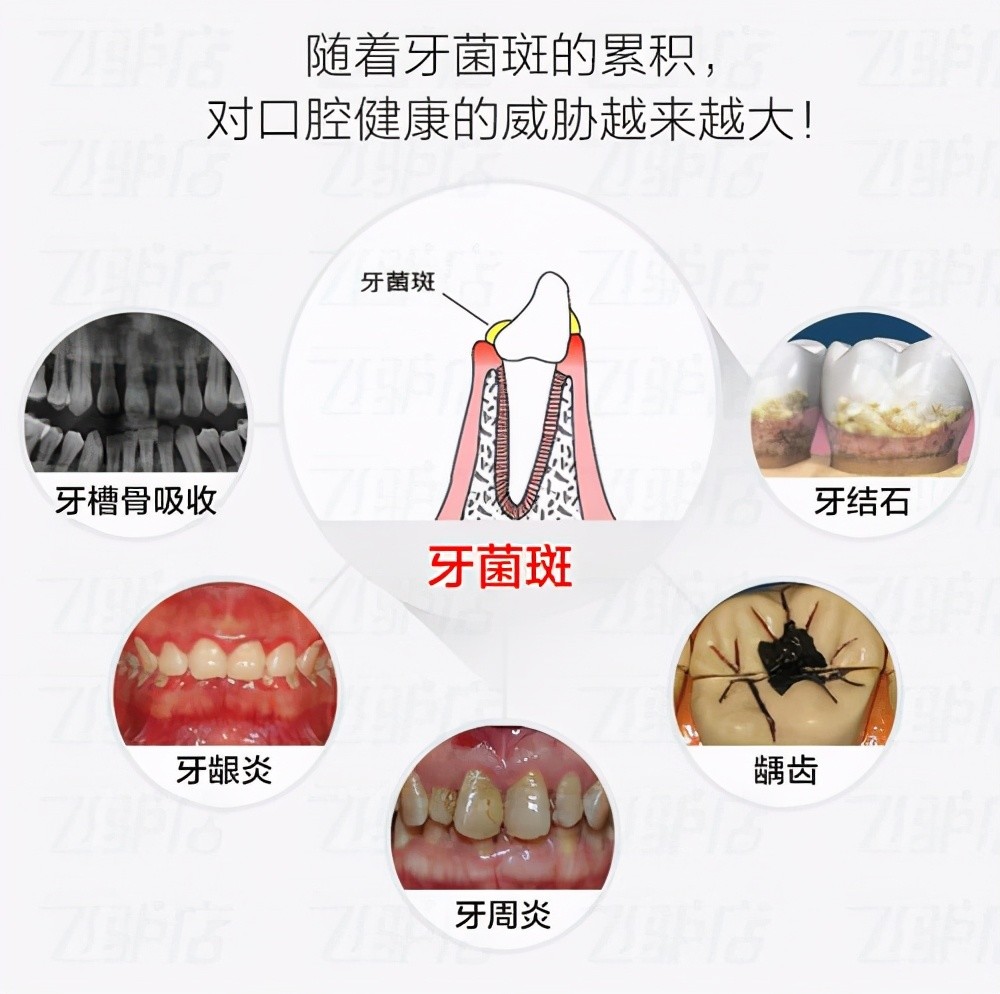 因此我们需要在日常生活中,加强口腔清洁,降低口腔内牙菌斑的数量,这