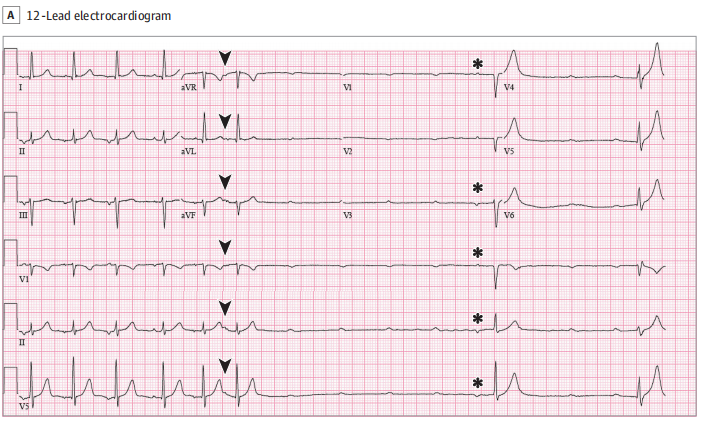 病例|心电图读图挑战-你能答对吗?