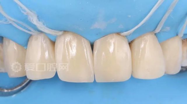 上颌前牙重度氟斑牙 龋坏树脂充填1例