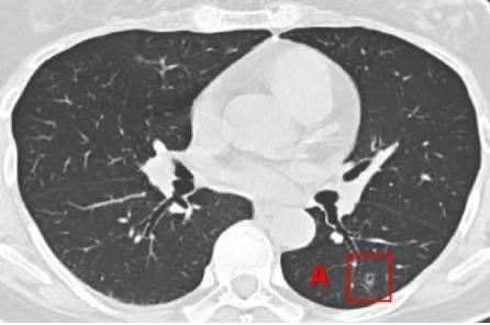 胸部ct看起来像是肺炎,最终确诊为肺癌!这种特殊肺癌易被误诊成肺炎