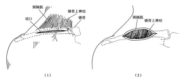 【骨科小技巧】锁骨前方显露手术路径!