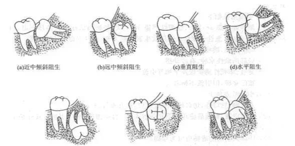 智齿知多少?(拔智齿必看)