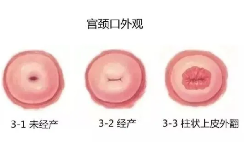 女人是否"打过胎",妇科医生一看便知,嘴上说的不牢靠