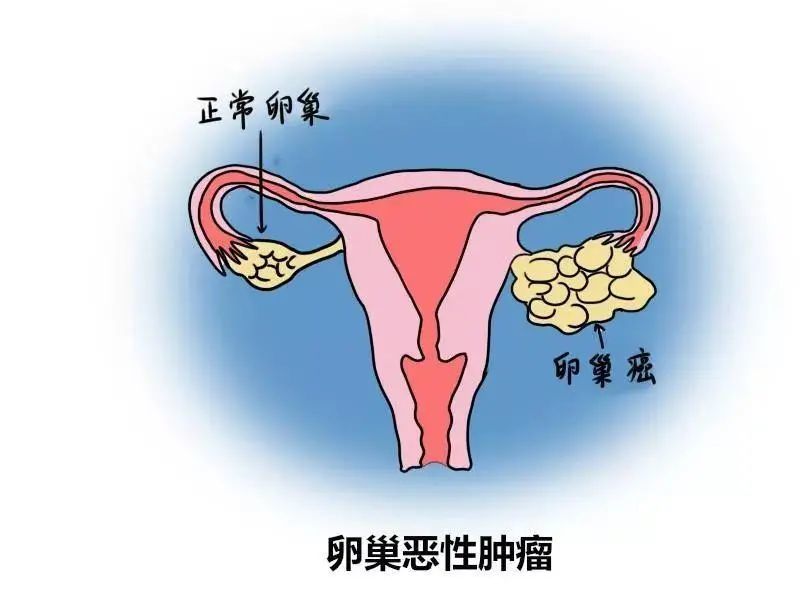 卵巢囊肿的危害有哪些?该怎么预防?