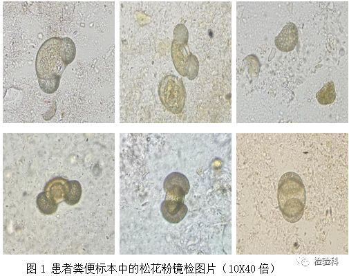 但潜血试验检测阳性,随后在显微镜检查过程中发现较多图1中形似"米奇"