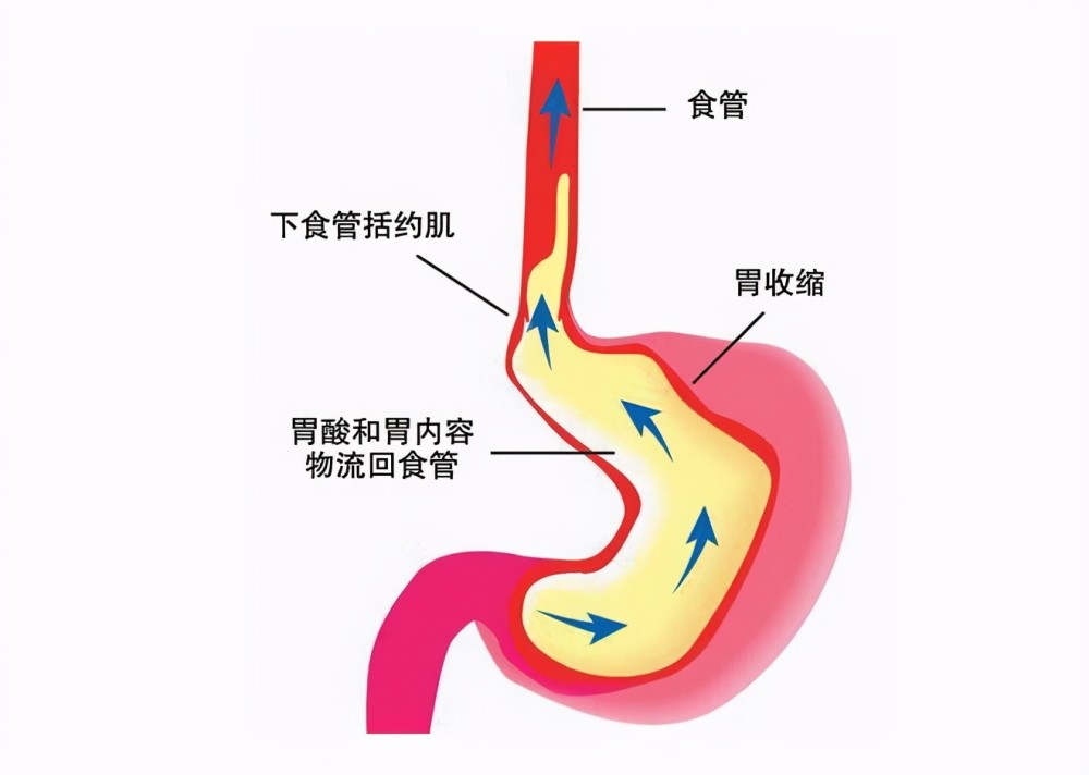 胃内容物反流到食管引起的胃,食管症状或黏膜组织损害的一类疾病