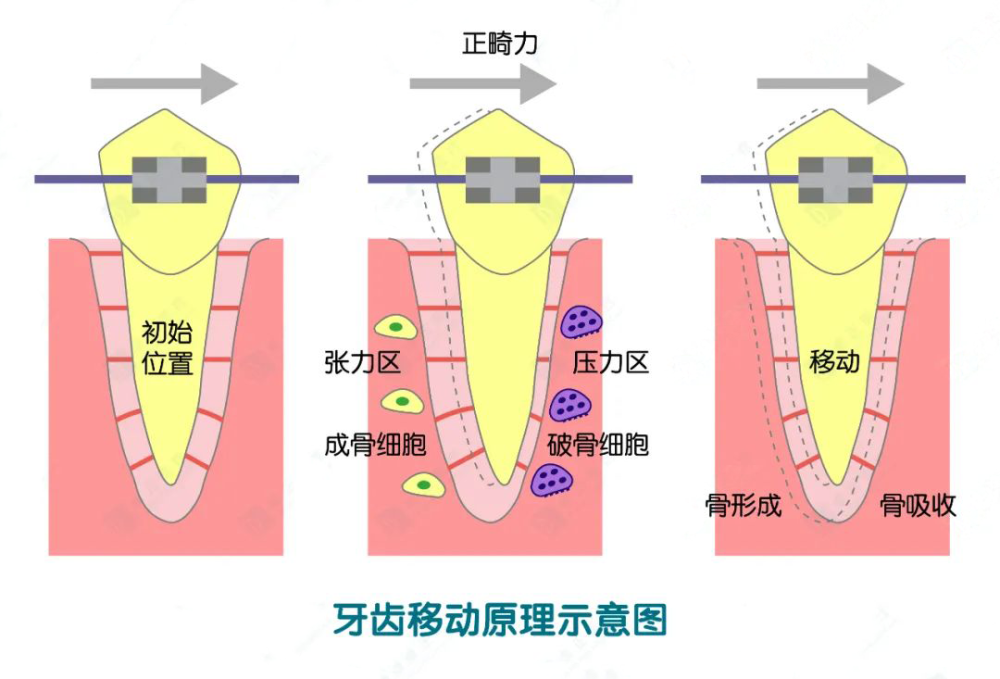 牙槽骨量的多少为什么很重要,这是因为牙齿移动的过程本质上就是 牙槽