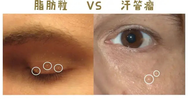 "未来医生科普"脂肪粒的锅到底应不应该眼霜来背