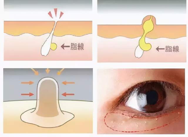 "未来医生科普"脂肪粒的锅到底应不应该眼霜来背