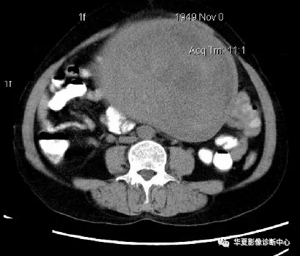 【经典】盆腔巨大肿块ct诊断与鉴别