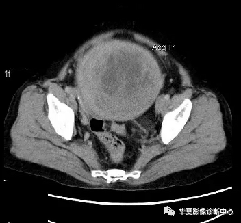 【经典】盆腔巨大肿块ct诊断与鉴别