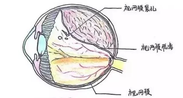 视网膜脱离不是小事,想要预防,就得牢记这些措施