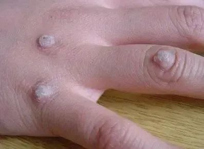 寻常疣可以发生在身体的任何部位,但手部多见,好发于手指和掌部,外伤