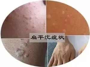 疣是由人乳头瘤病毒( hpv )感染所引起的皮肤表面良性赘生物,可以发生