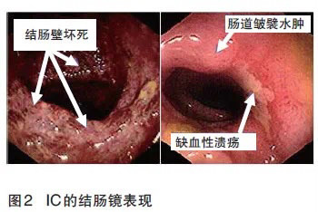 缺血性结肠炎诊治攻略