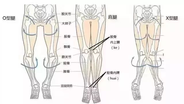 并且,部分失衡性o型腿由于同时伴随髋关节的外展移位,会导致双腿间的