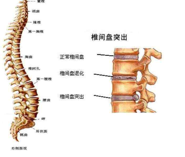 腰间盘突出应该多运动还是多休息?