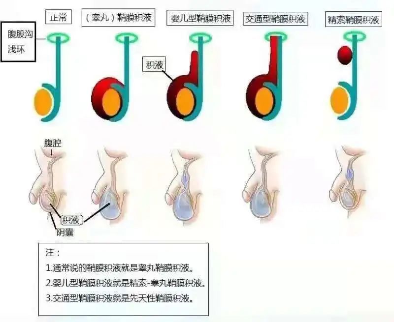(鞘膜积液类型)针对腹股沟疝气和鞘膜积液的手术治疗,我院主要是采用