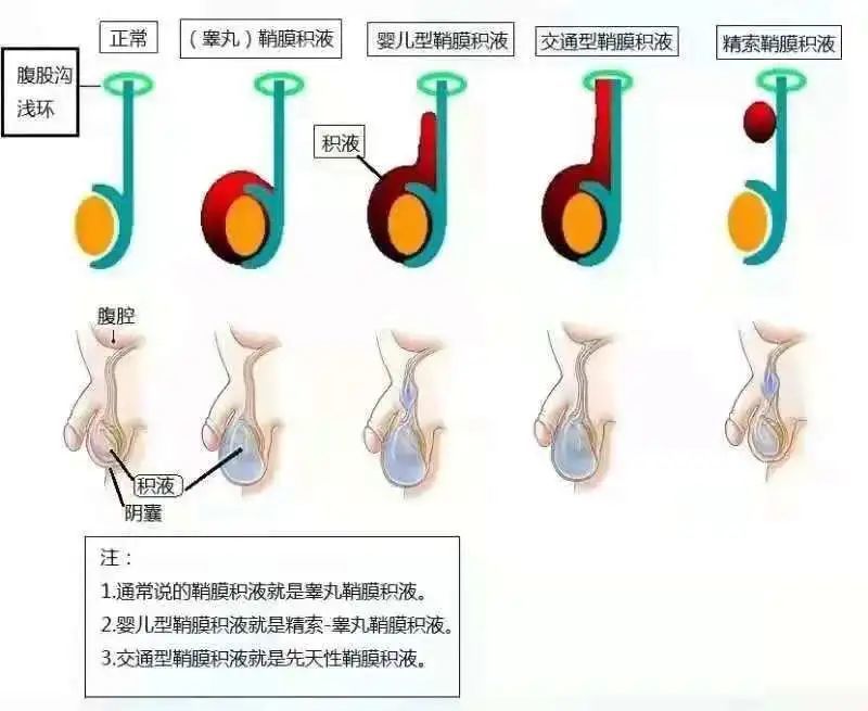 (鞘膜积液类型)