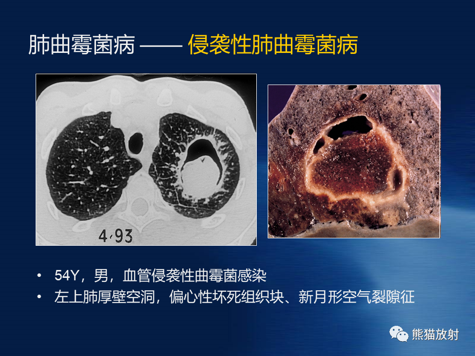 肺真菌病丨影像学表现与病理对照