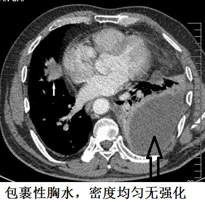 包裹性的胸水,可以水往高处走,但是密度一般非常均匀,密度很低,如下图