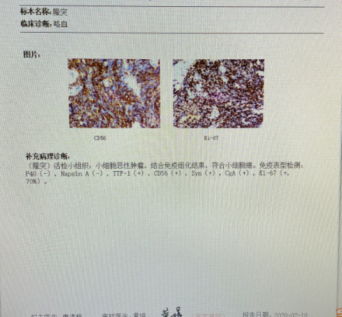 病理穿刺细胞学结果(2020-02-10):淋巴结转移性癌,倾向小细胞癌