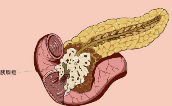 胰腺癌不是悄悄来临出现3个症状或要留心观察别再忽视