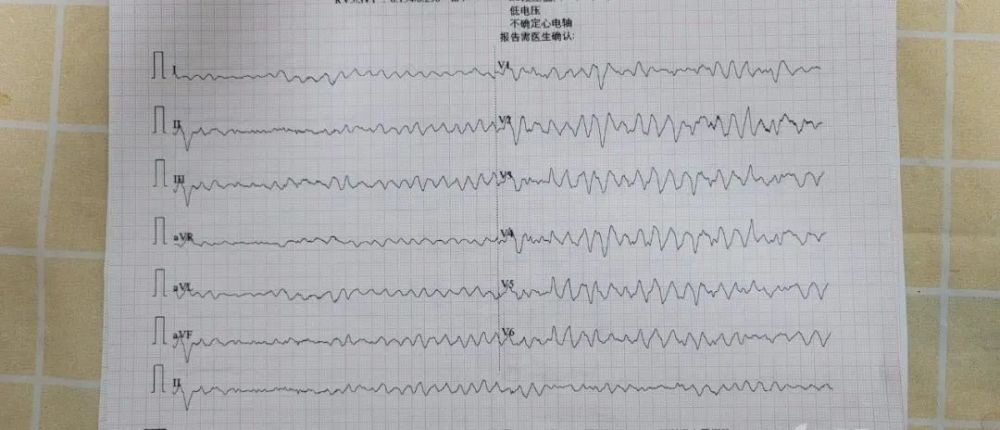 患者突发室颤抢救无效死亡,这个病例忽略了什么?