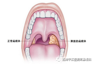 扁桃体和腺样体,到底要不要全切?