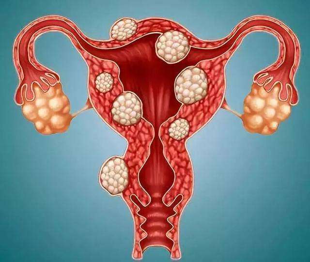 重庆仁爱妇科医院讲解:子宫肌瘤的预防方法是什么