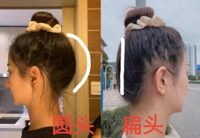 医学上有一种症状叫做 扁头综合征,指的就是偏头,扁头,斜头,尖头等