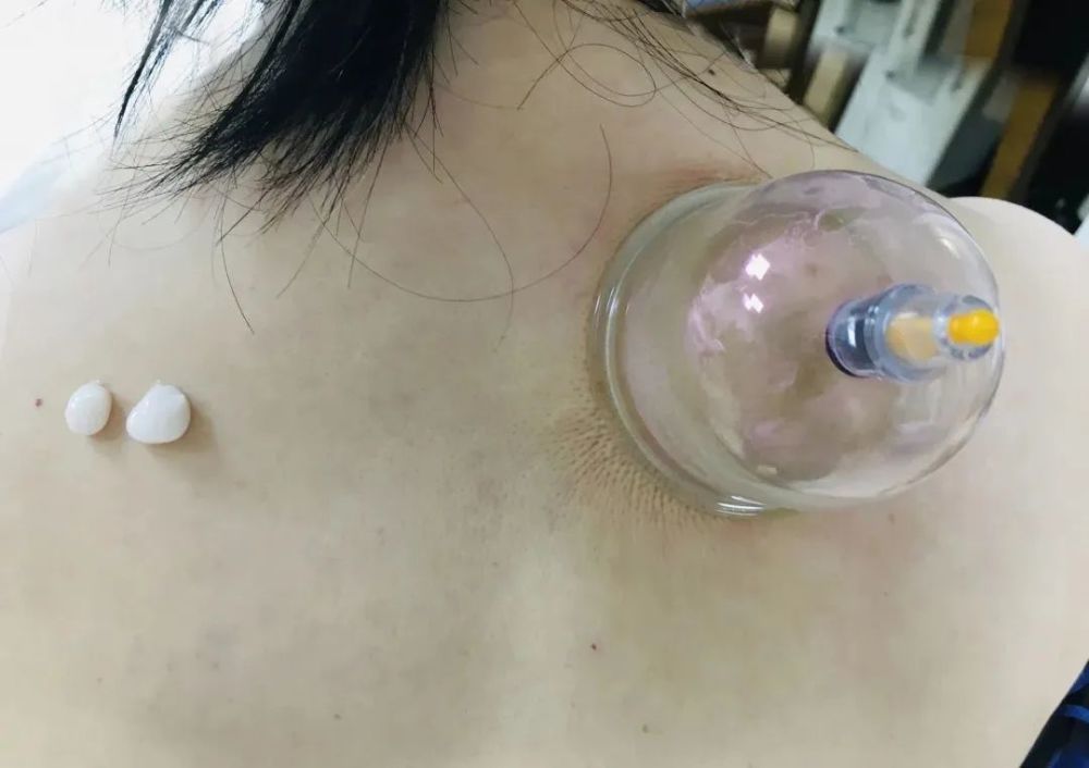肩颈背经常酸痛低头族久坐必备用它一抹发热堪比拔罐刮痧舒服极了
