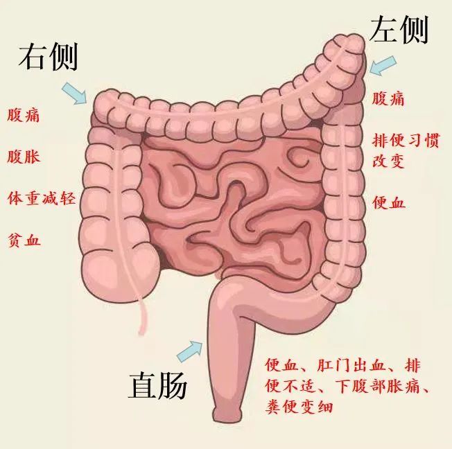 【天天健康】重视肠道预防保健,尽早诊治结直肠癌!