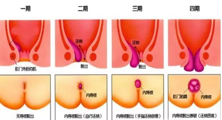 20岁小伙患痔疮,失掉全身2/3血量!原因竟是你我都会犯