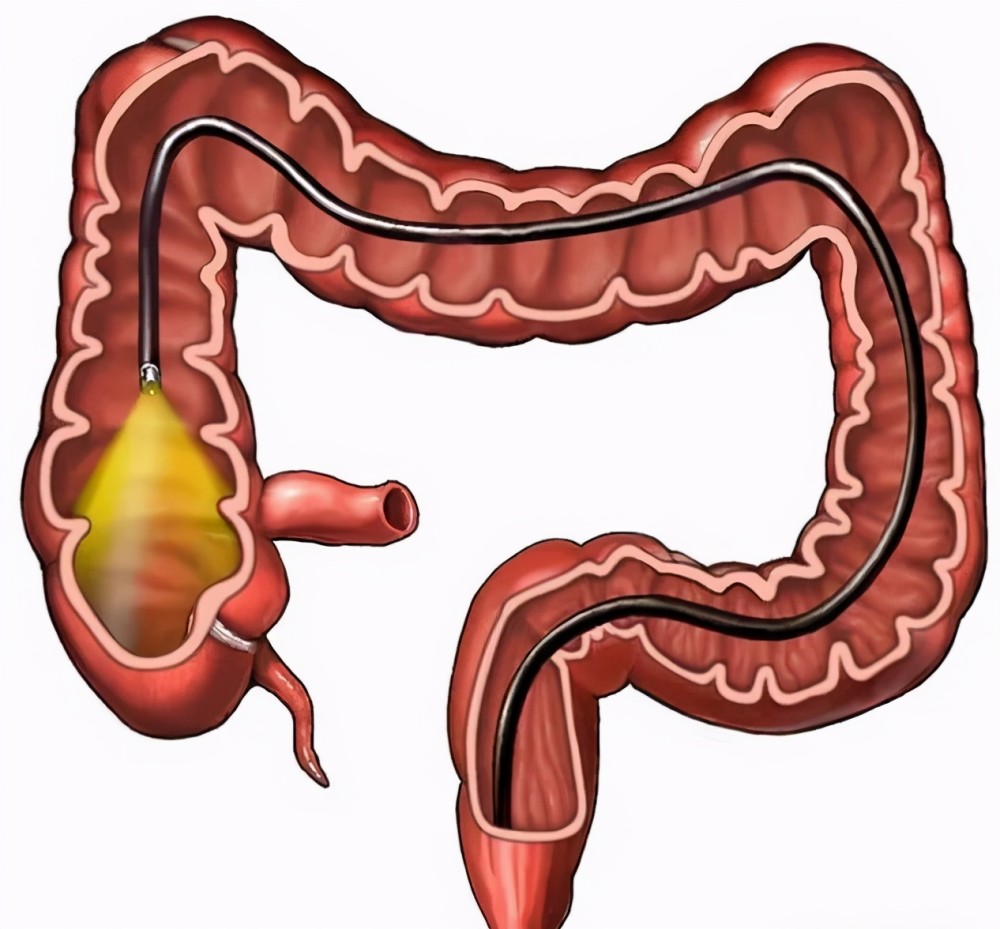 无痛肠镜,会不会增加肠穿孔的风险?还能做吗?