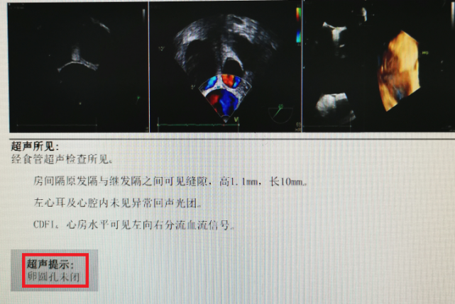 经食管超声(tee)显示卵圆孔未闭