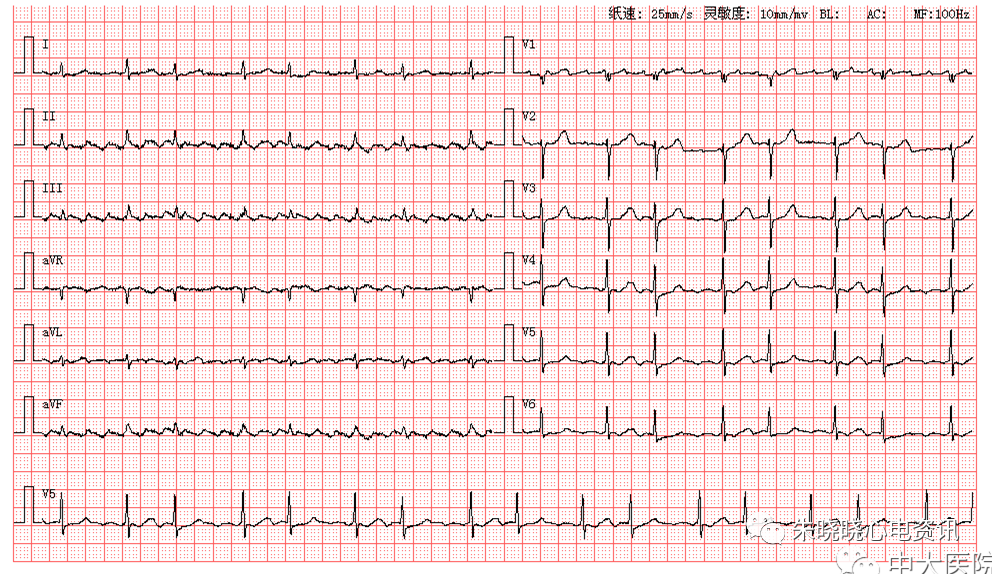 每日读图|第1429期 房扑 肢体导联qrs低电压