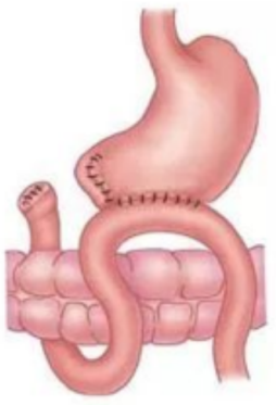 7  胃部分切除术伴胃空肠吻合术