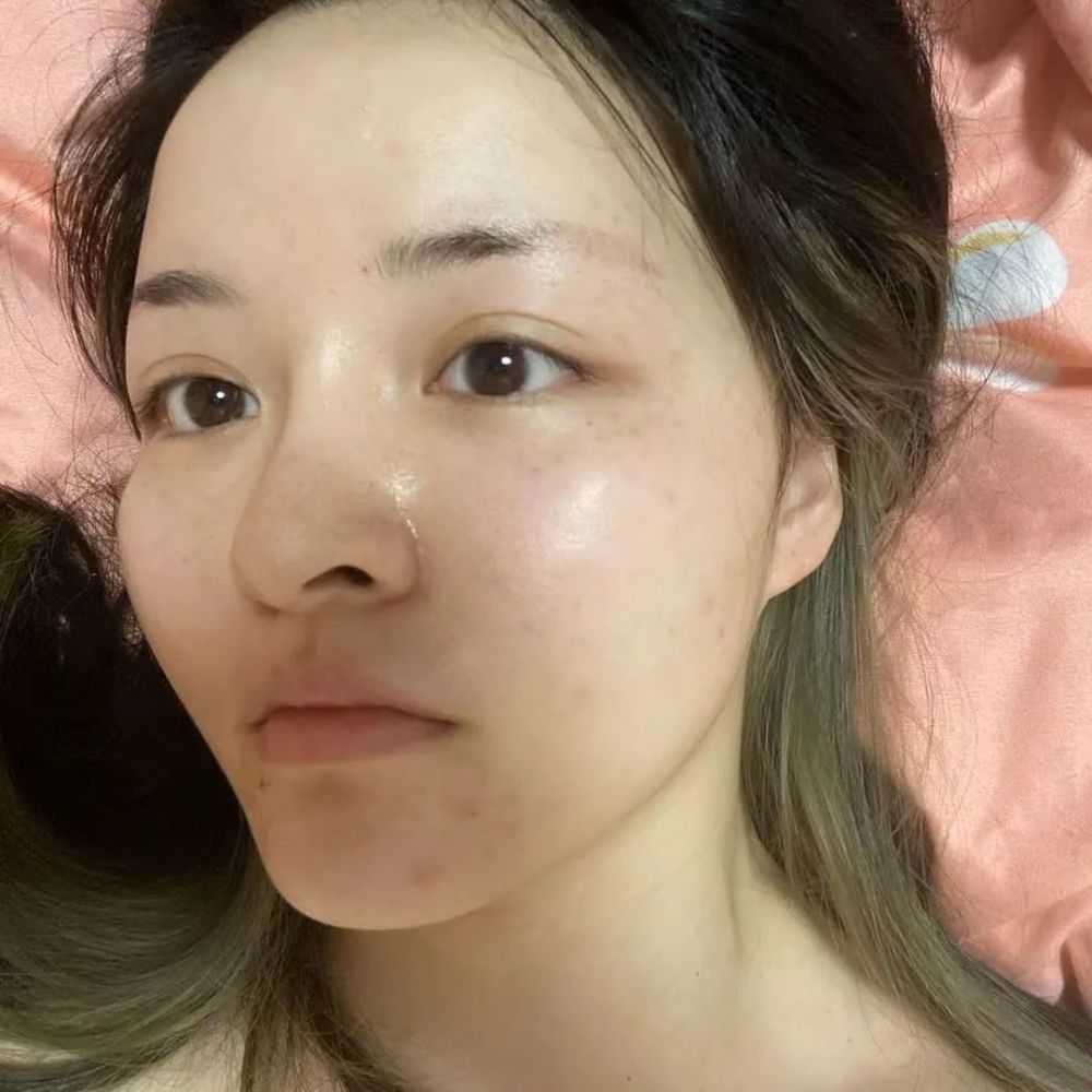 现在化完妆几乎看不到痘痘啦!还有就是大面积爆痘医生都说不要敷面膜!