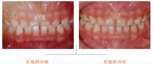 天包地地包天等孩子换完牙再矫治晚了