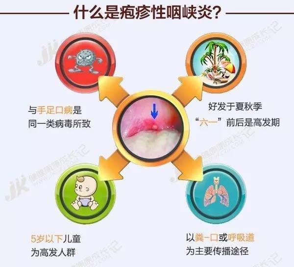 儿科专家提示:注意辨别这个夏季儿童高发传染性疾病——疱疹性咽峡炎