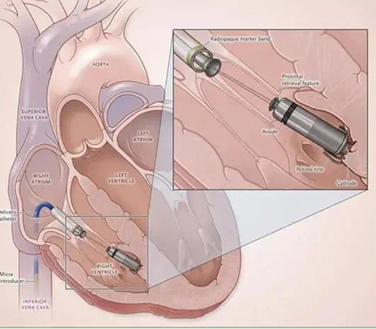 显著减少传统心脏起搏器植入术的创伤和感染风险,且手术耗时及术后