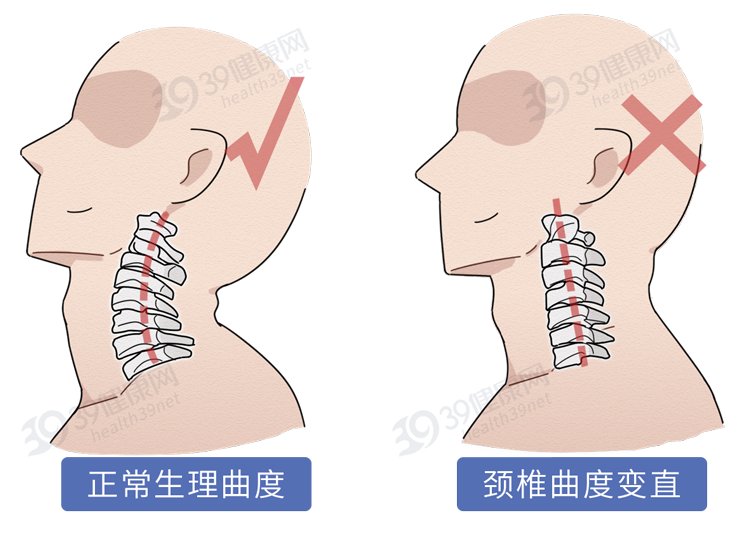 时间长了还会让颈椎曲度变直导致颈部肌肉紧张劳累枕头太高容易造成