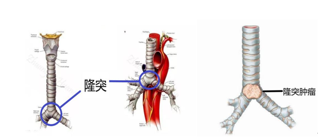沈阳市胸科医院完成东北首例ecmo下气管隆突重建手术
